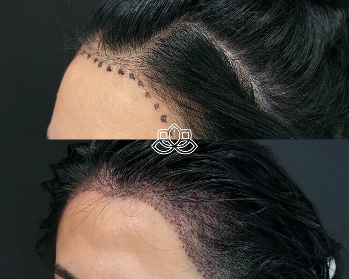 Injerto de Cabello para Mujeres