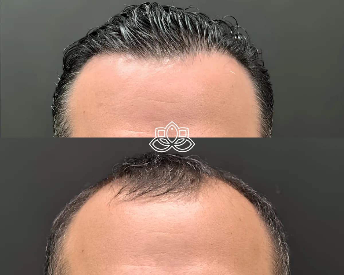 Injerto de Cabello Avanzado