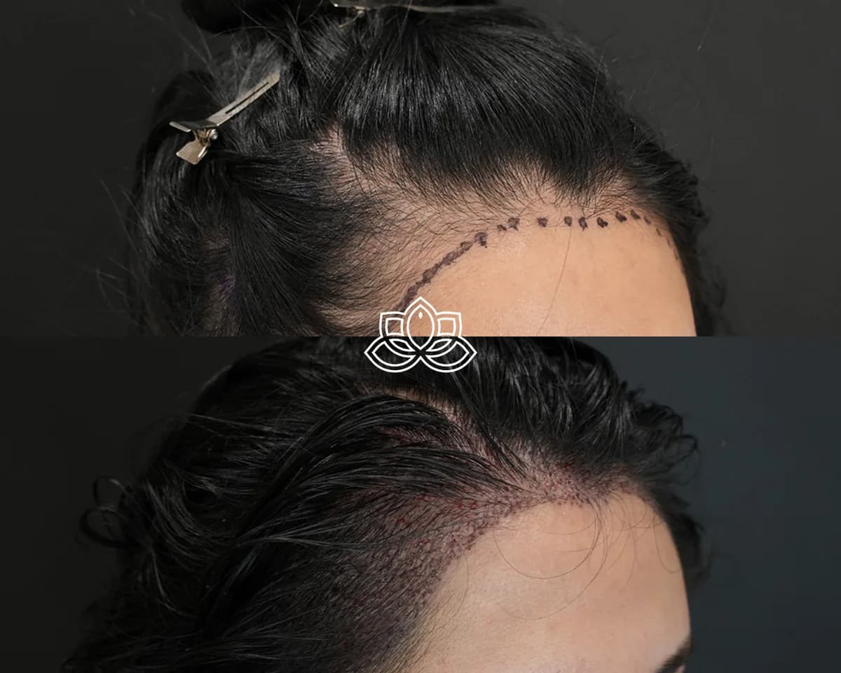 Injerto de Cabello para Mujeres 2